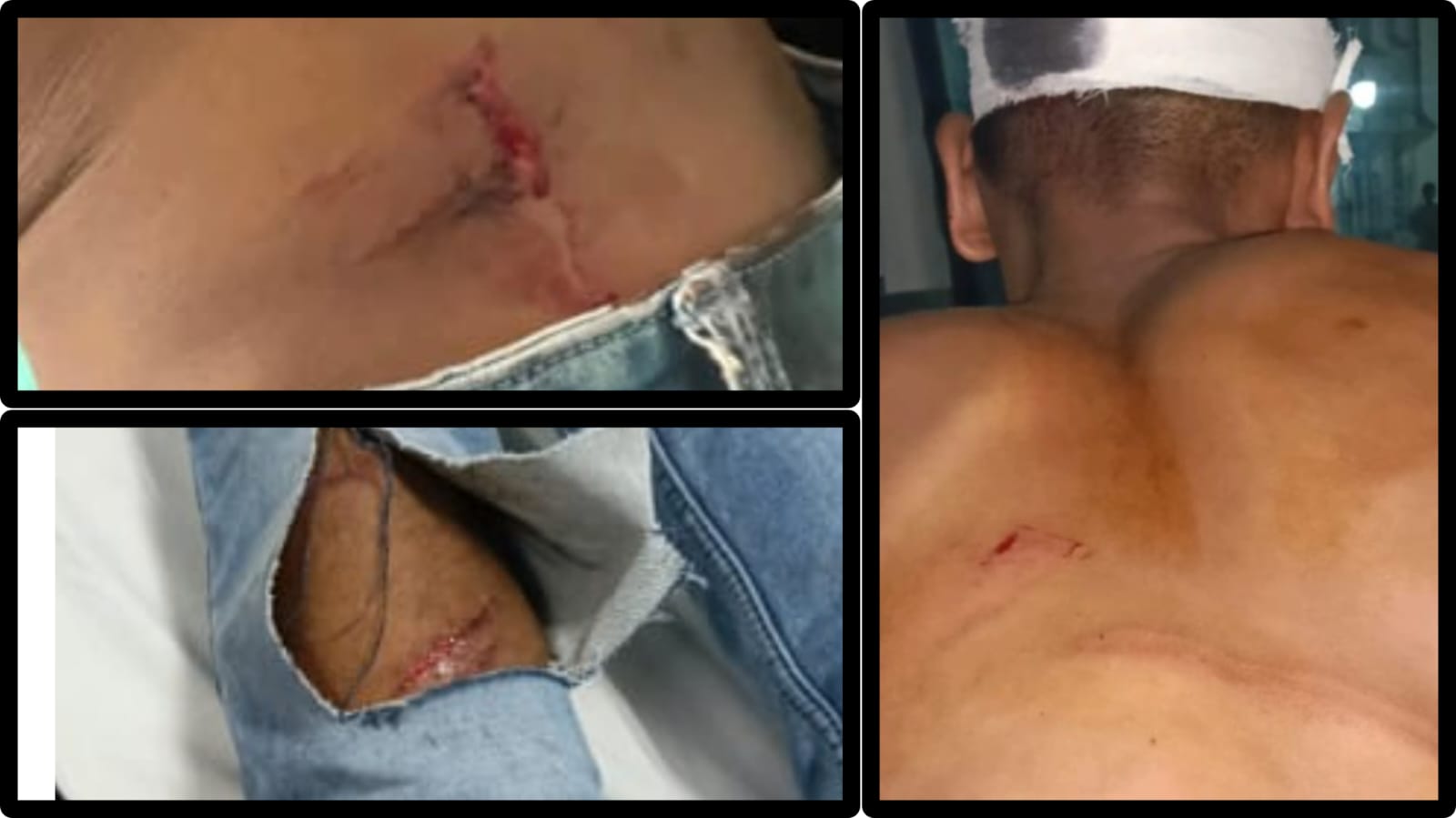 एक दूसरे को घायल कर थाने पहुंचें नशा तस्करों के लोग…